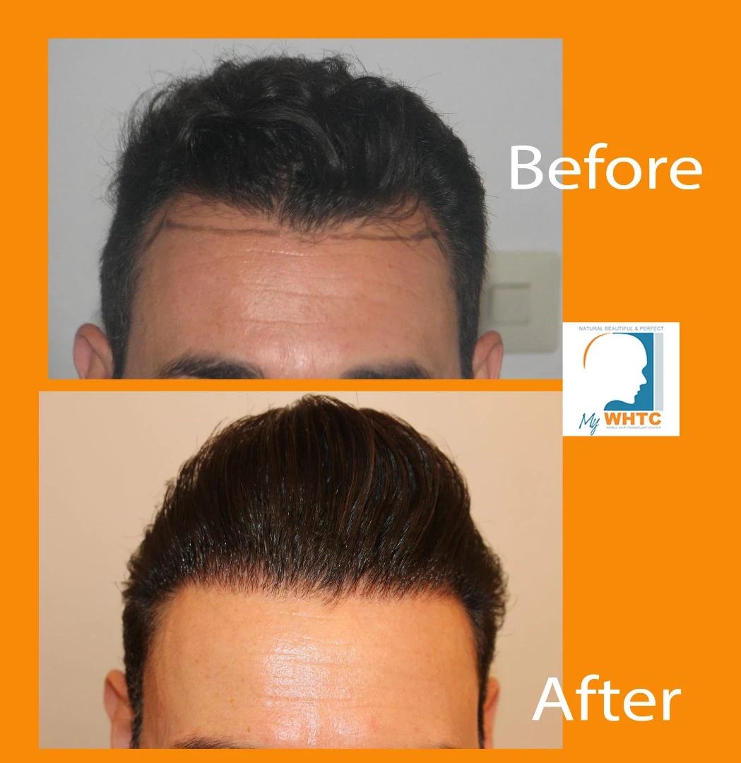 Dr Patrick Mwamba Hair transplant result