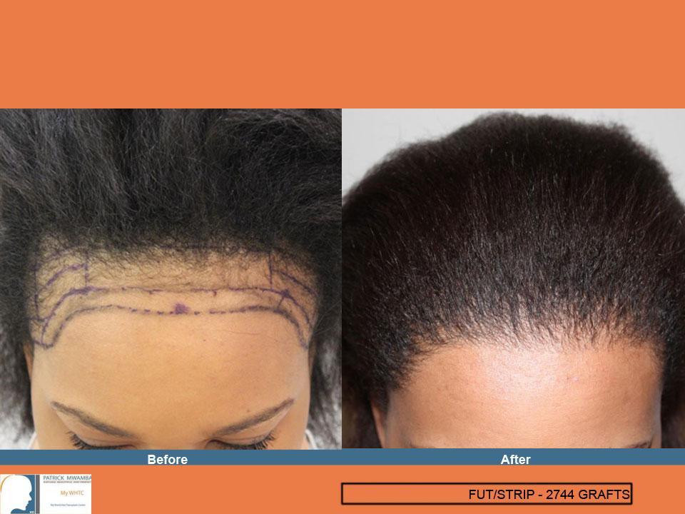 Dr Patrick Mwamba Hair transplant result