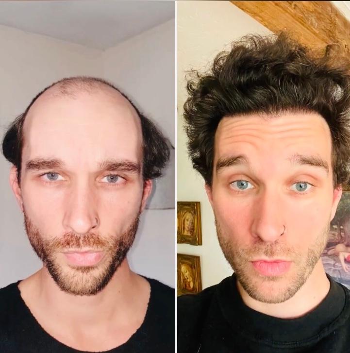 Dr Patrick Mwamba Hair transplant result