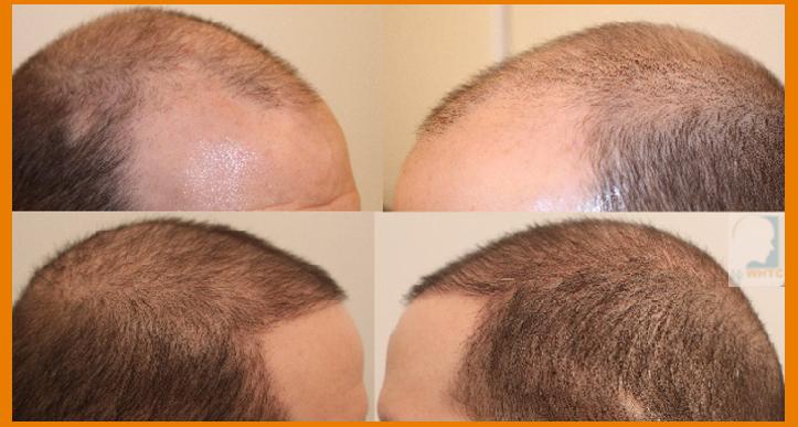 Dr Patrick Mwamba Hair transplant result