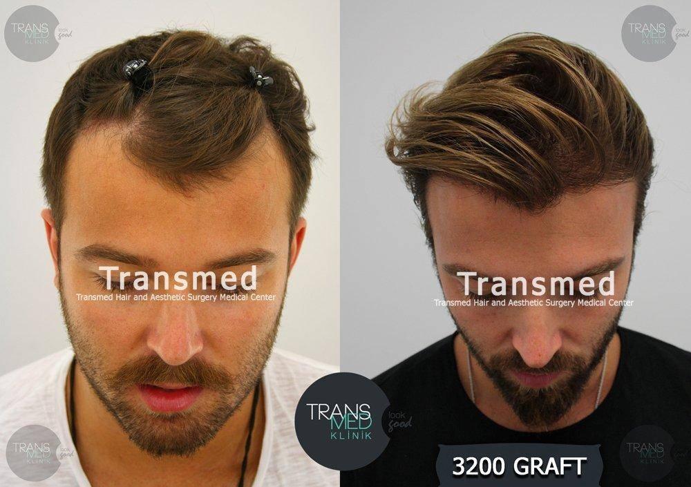 Transmed Hair Clinic Istanbul2