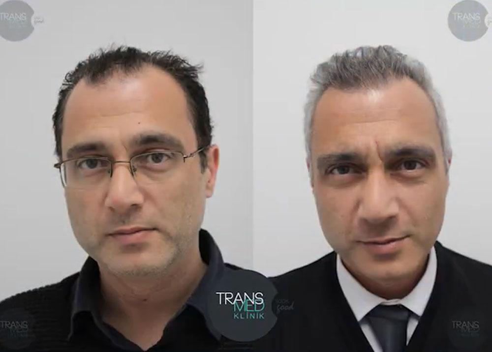 Transmed Hair Clinic result