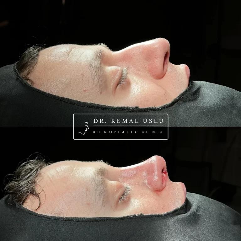 Dr Kemal Uslu Rhinoplasty