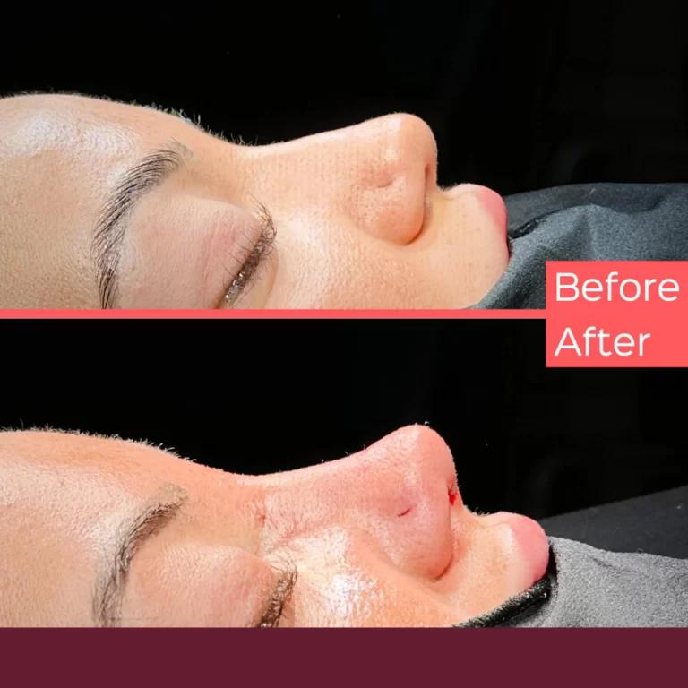 Dr Kemal Uslu Rhinoplasty