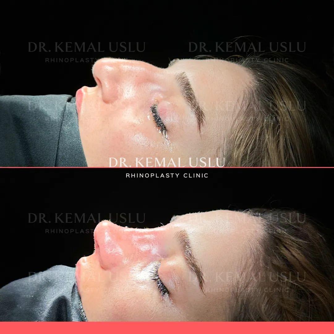 Dr Kemal Uslu Rhinoplasty