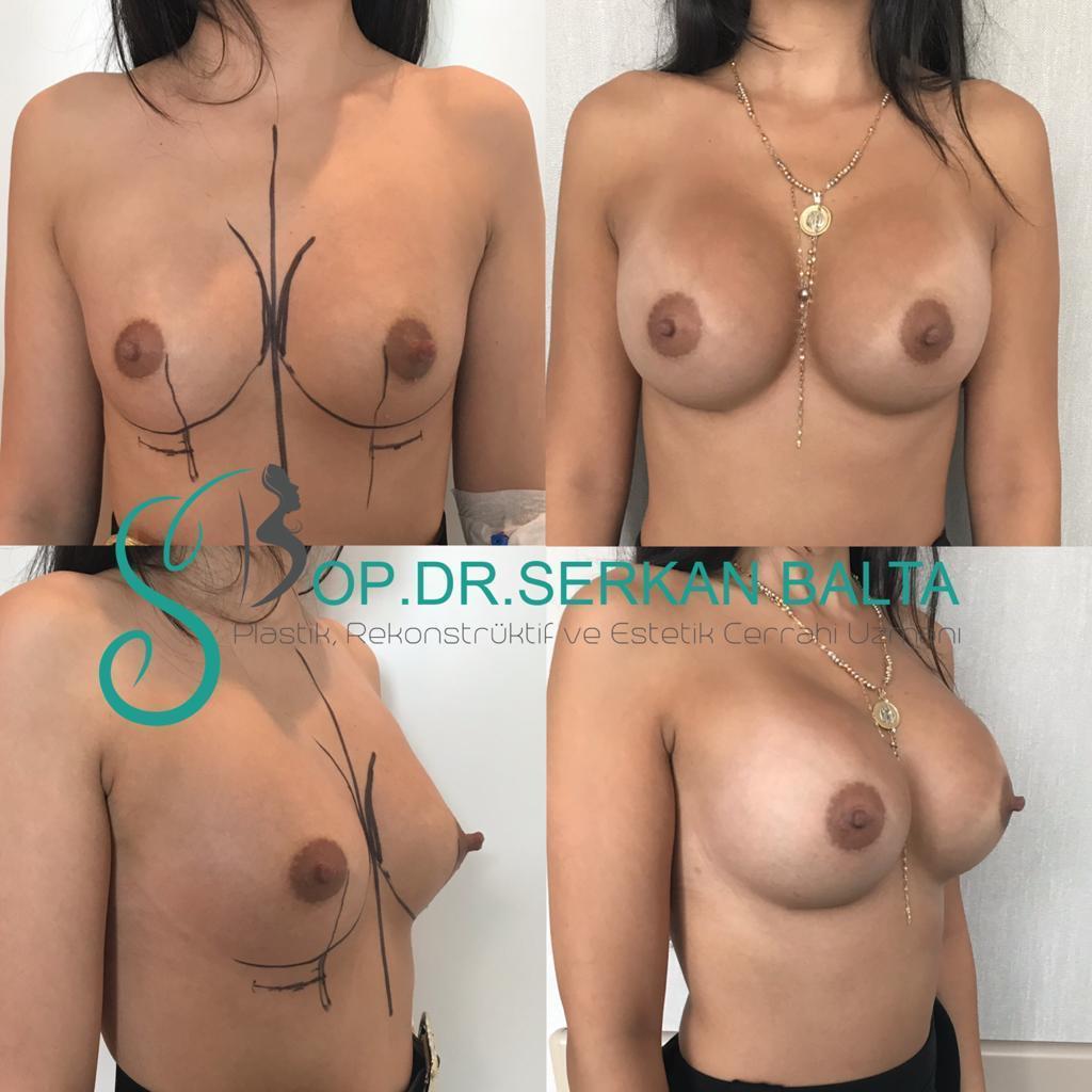 ELIT CLINIC COSMETIC SURGERY RESULTS 23