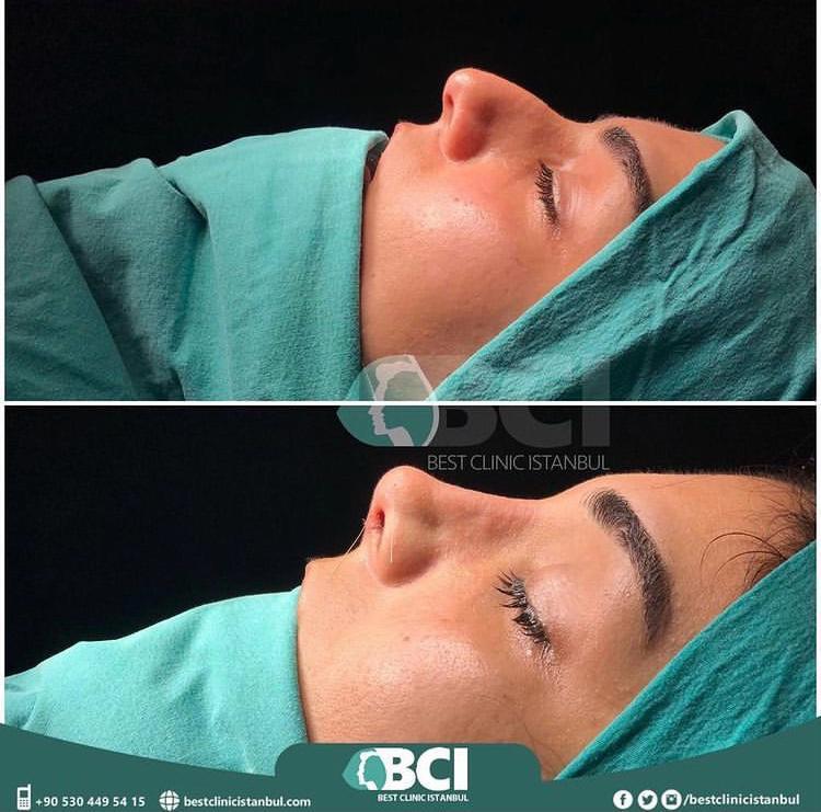 ELIT CLINIC COSMETIC SURGERY RESULTS 21