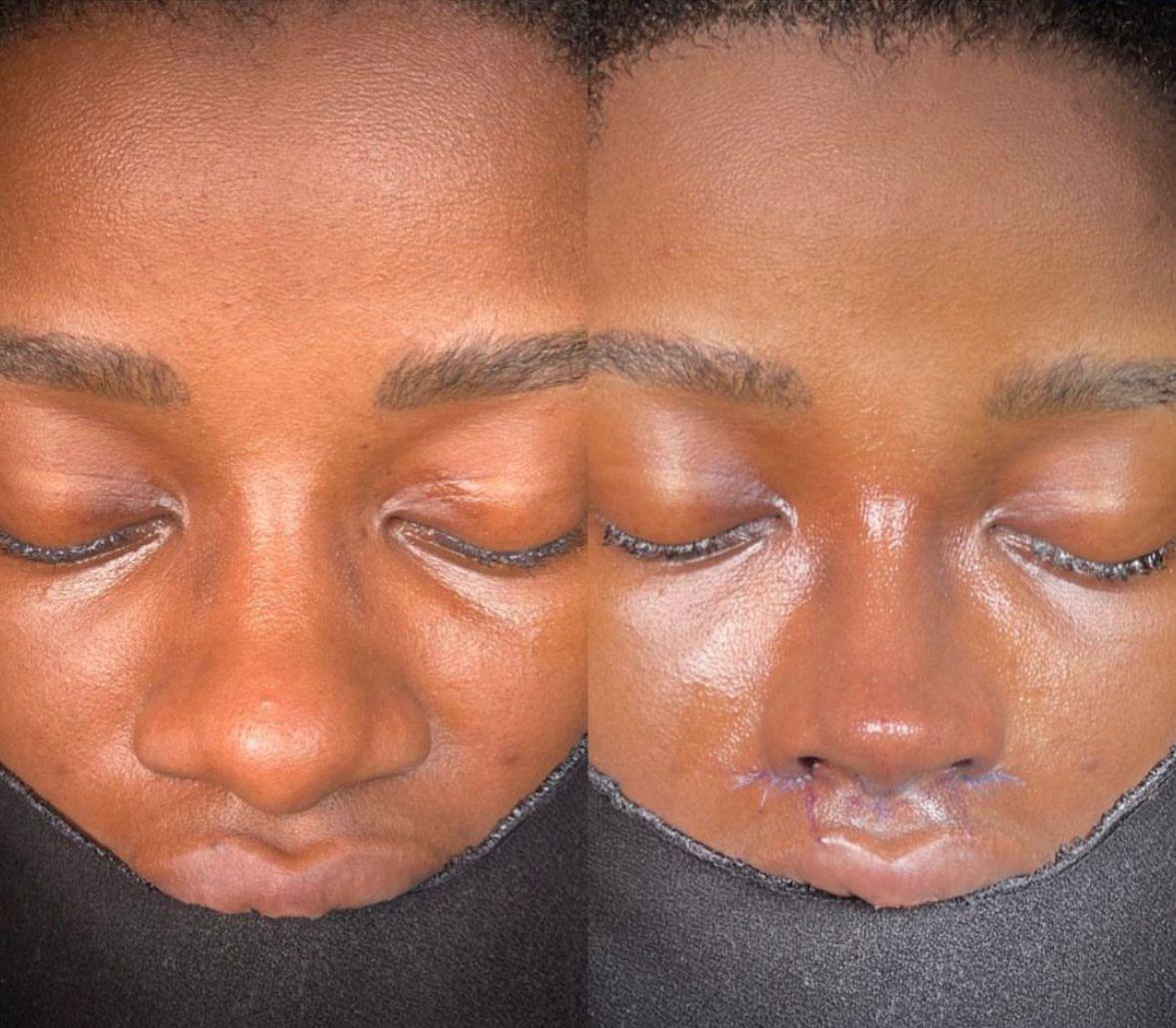 Dr Kemal Uslu Rhniplastie Ethnique - Etnic rhino3