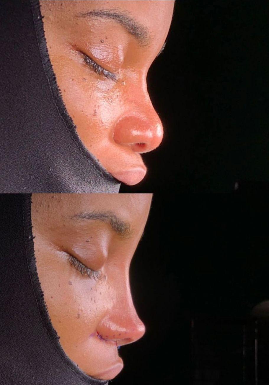 Dr Kemal Uslu Rhniplastie Ethnique - Etnic rhino4