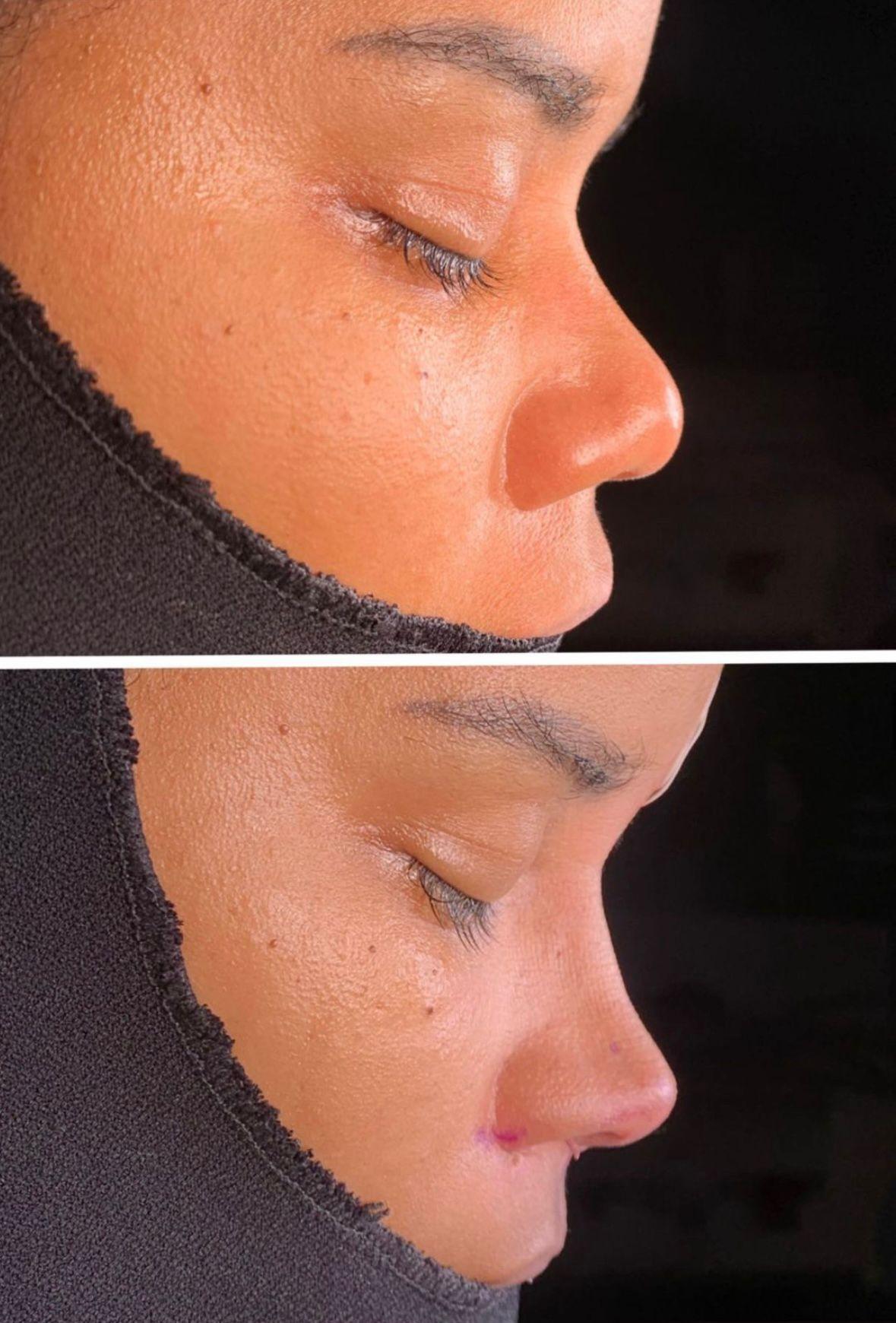 Dr Kemal Uslu Rhniplastie Ethnique - Etnic rhino5