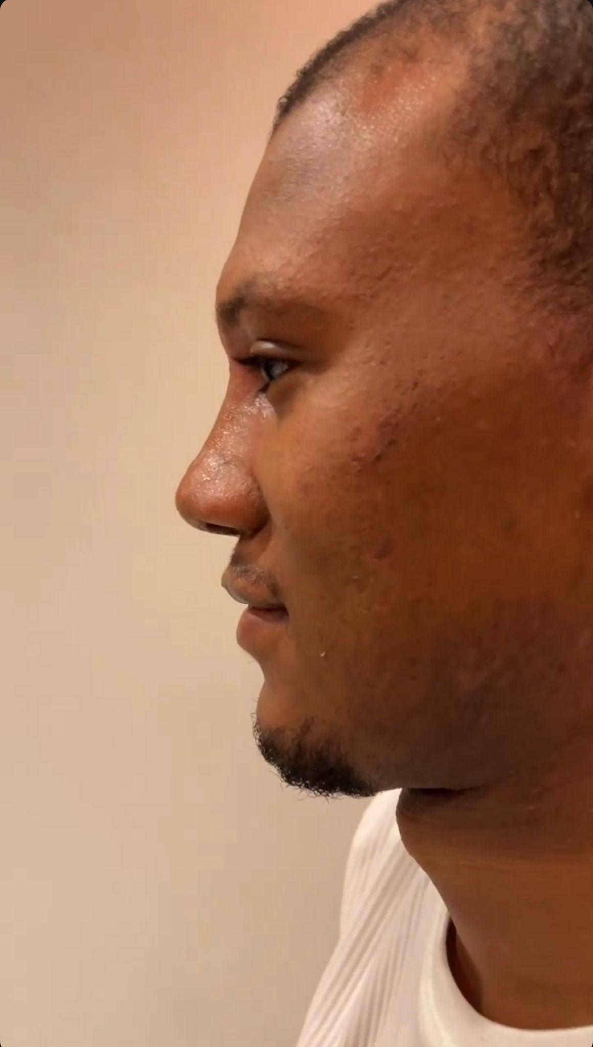 Dr Kemal Uslu Rhniplastie Ethnique - Etnic rhino6