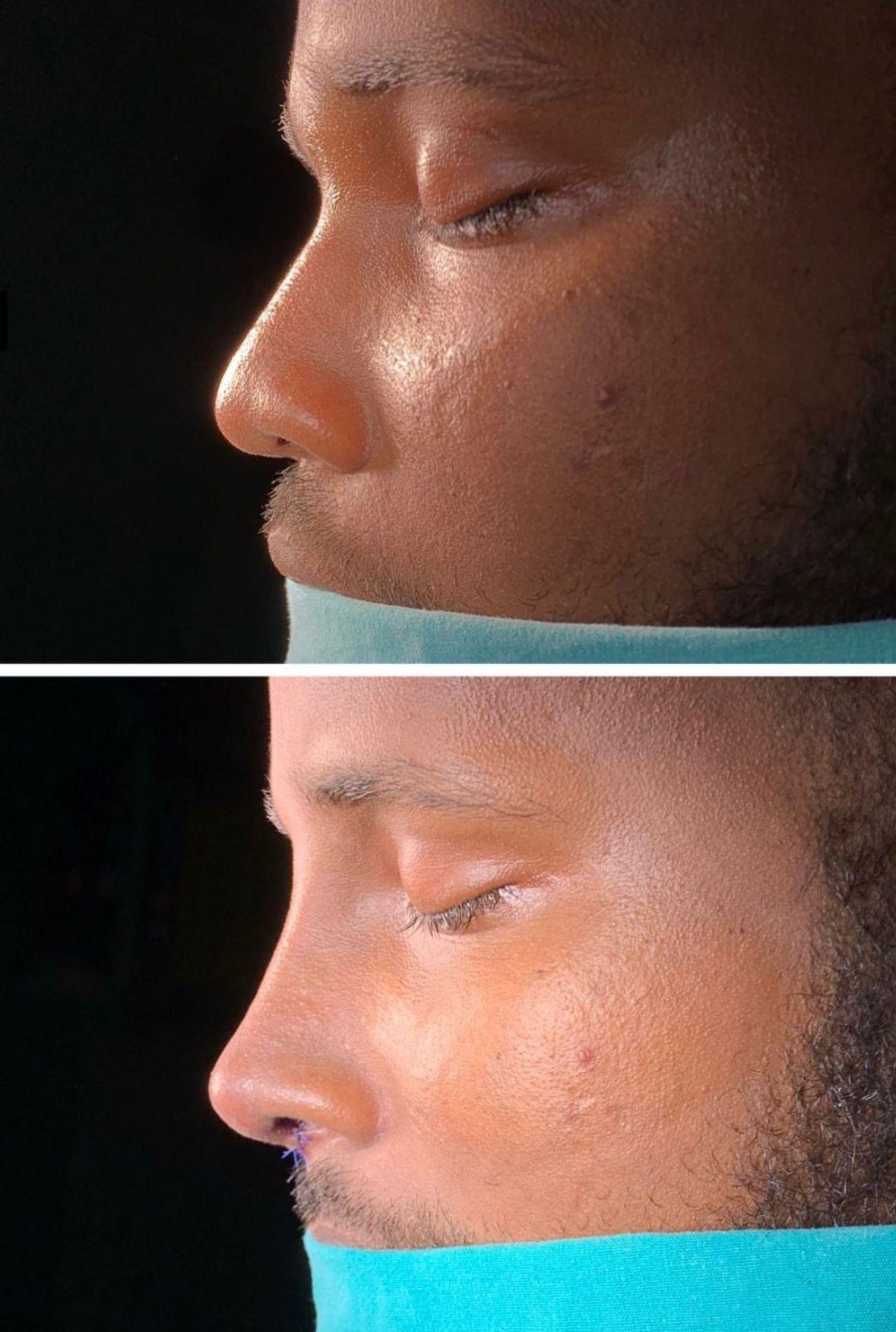 Dr Kemal Uslu Rhniplastie Ethnique - Etnic rhino7