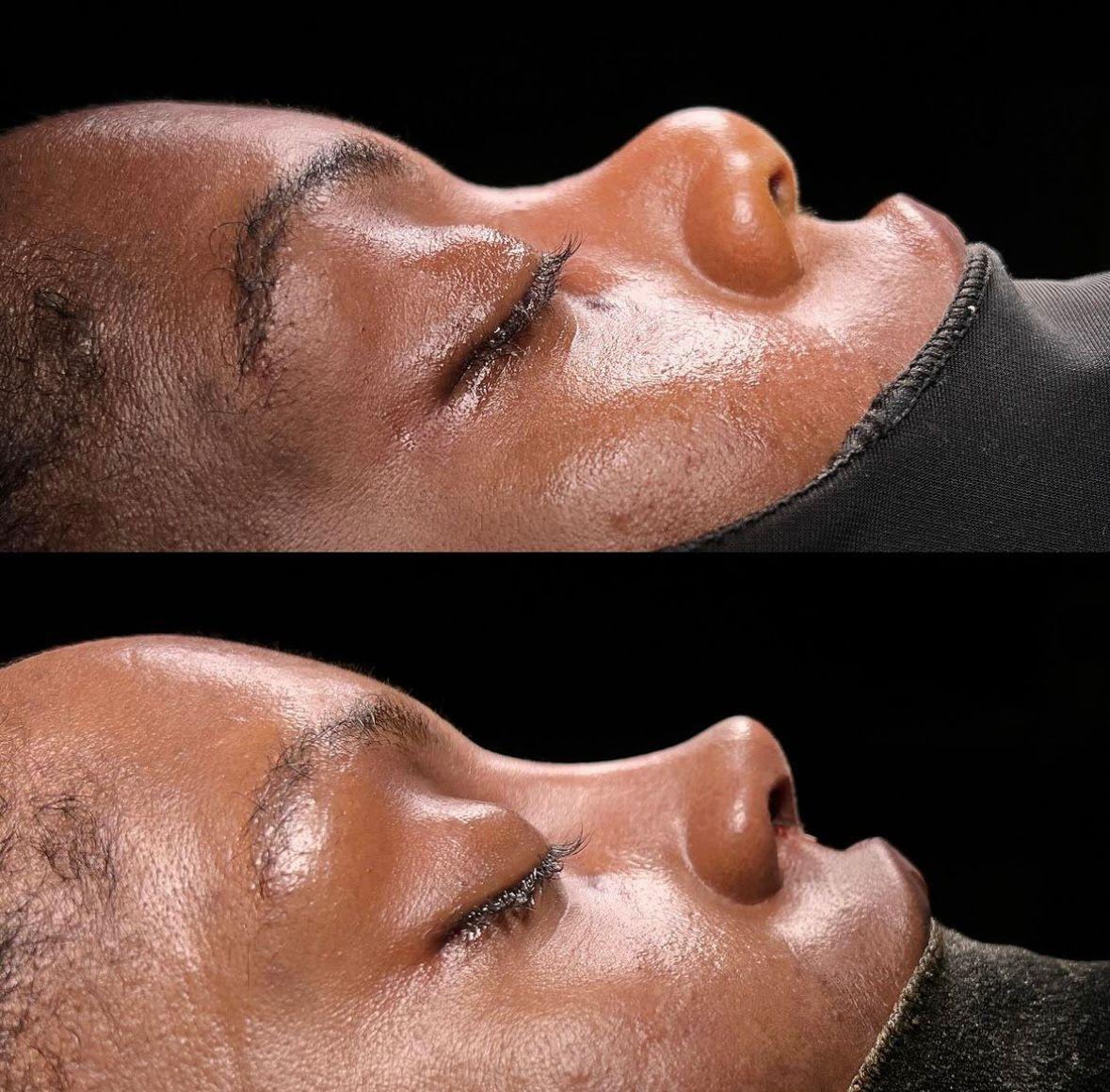 Dr Kemal Uslu Rhniplastie Ethnique - Etnic rhino8