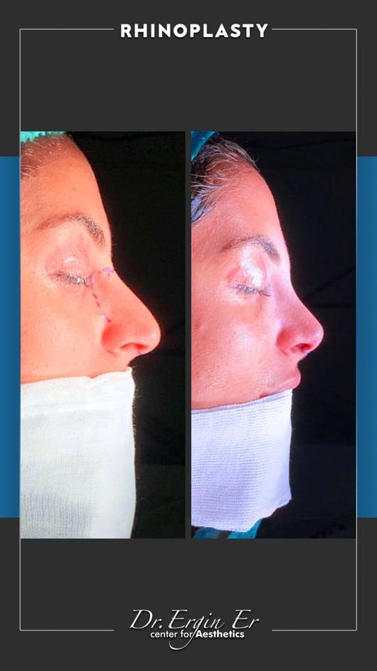 DR ERGIN ER ISTANBUL RHINOPLASTY5