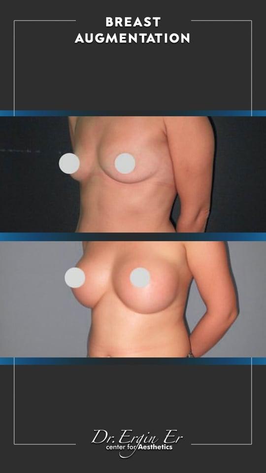 DR ERGIN ER ISTANBUL RESULTS SURGERY 17