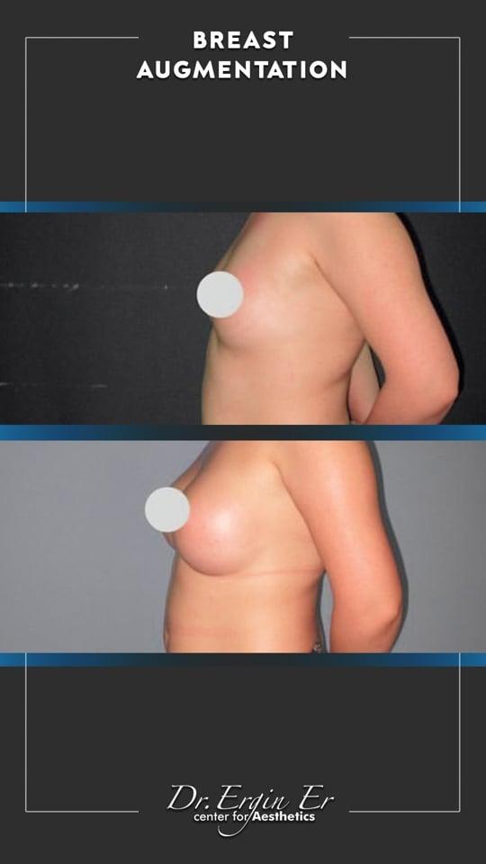 DR ERGIN ER ISTANBUL RESULTS SURGERY 22