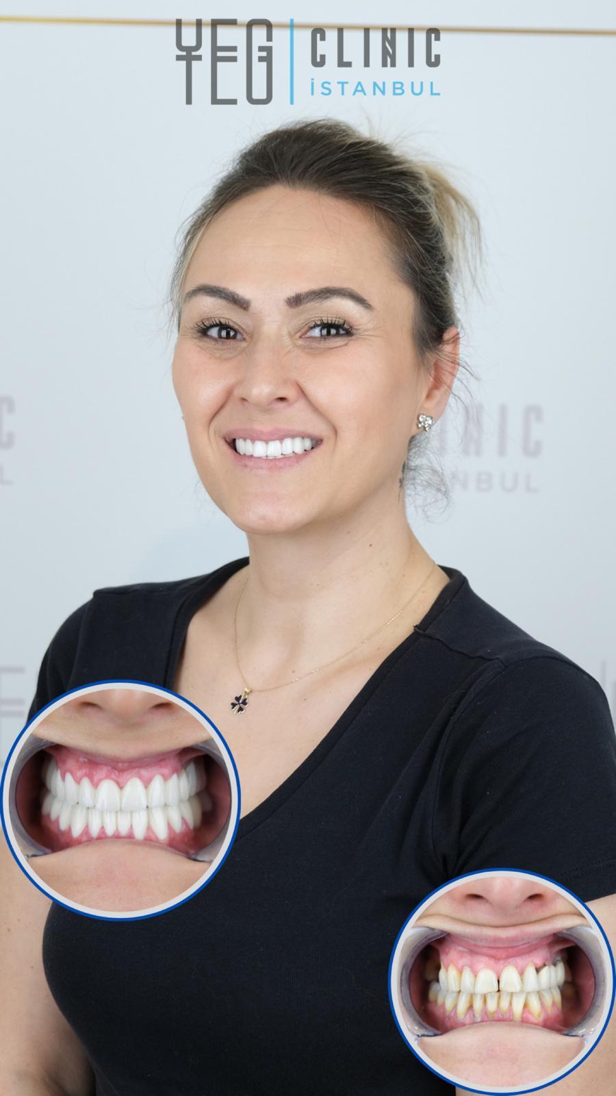 Yeg Clinic Istanbul Crowns X 20