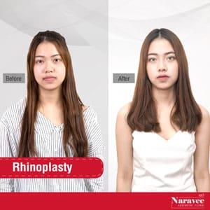rhinoplastie-naravee1-min