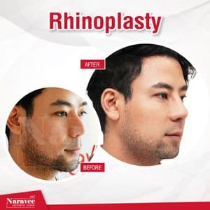 rhinoplastie-naravee2-min