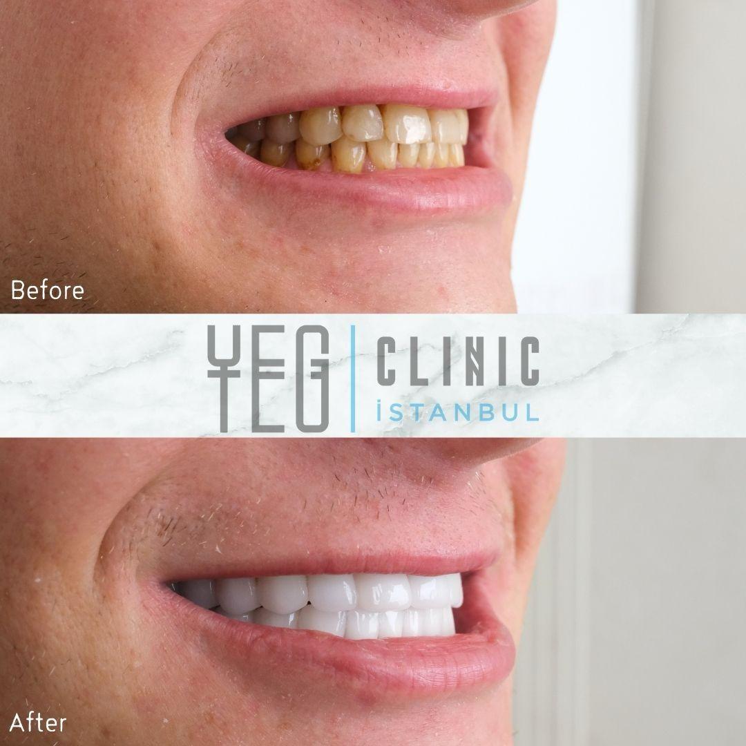 Emax Veneers