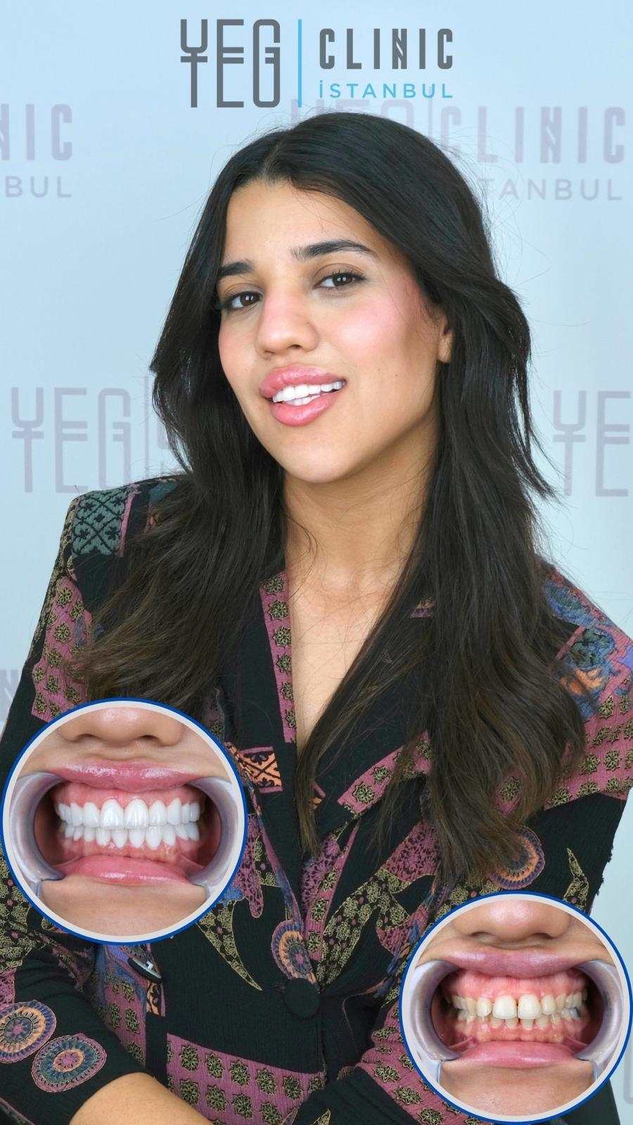 Hollywood Smile