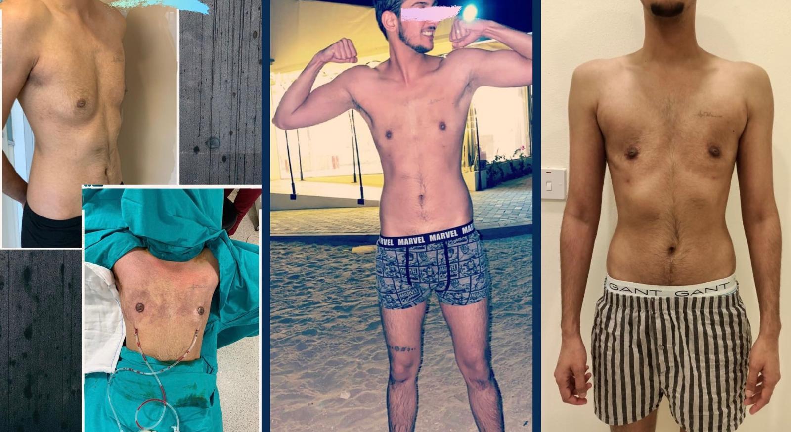 mastectomy results74