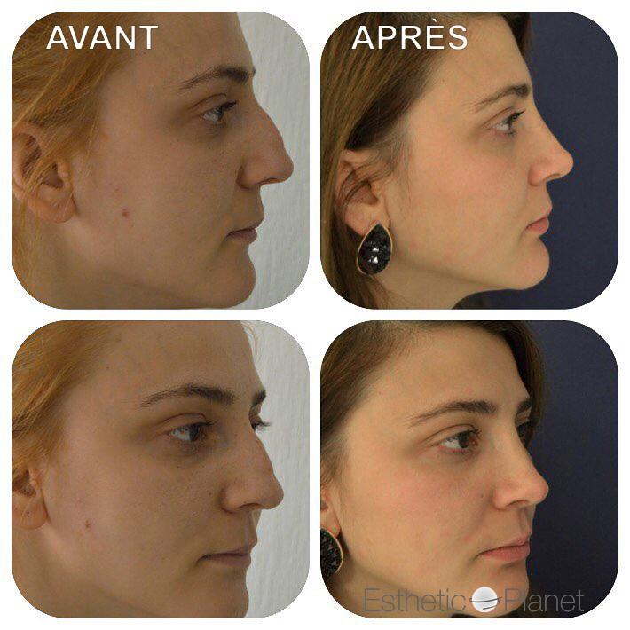 Rhinoplastie by Dr Ergin Er