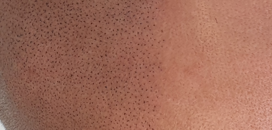 Scalp Micro Pigmentation result close up