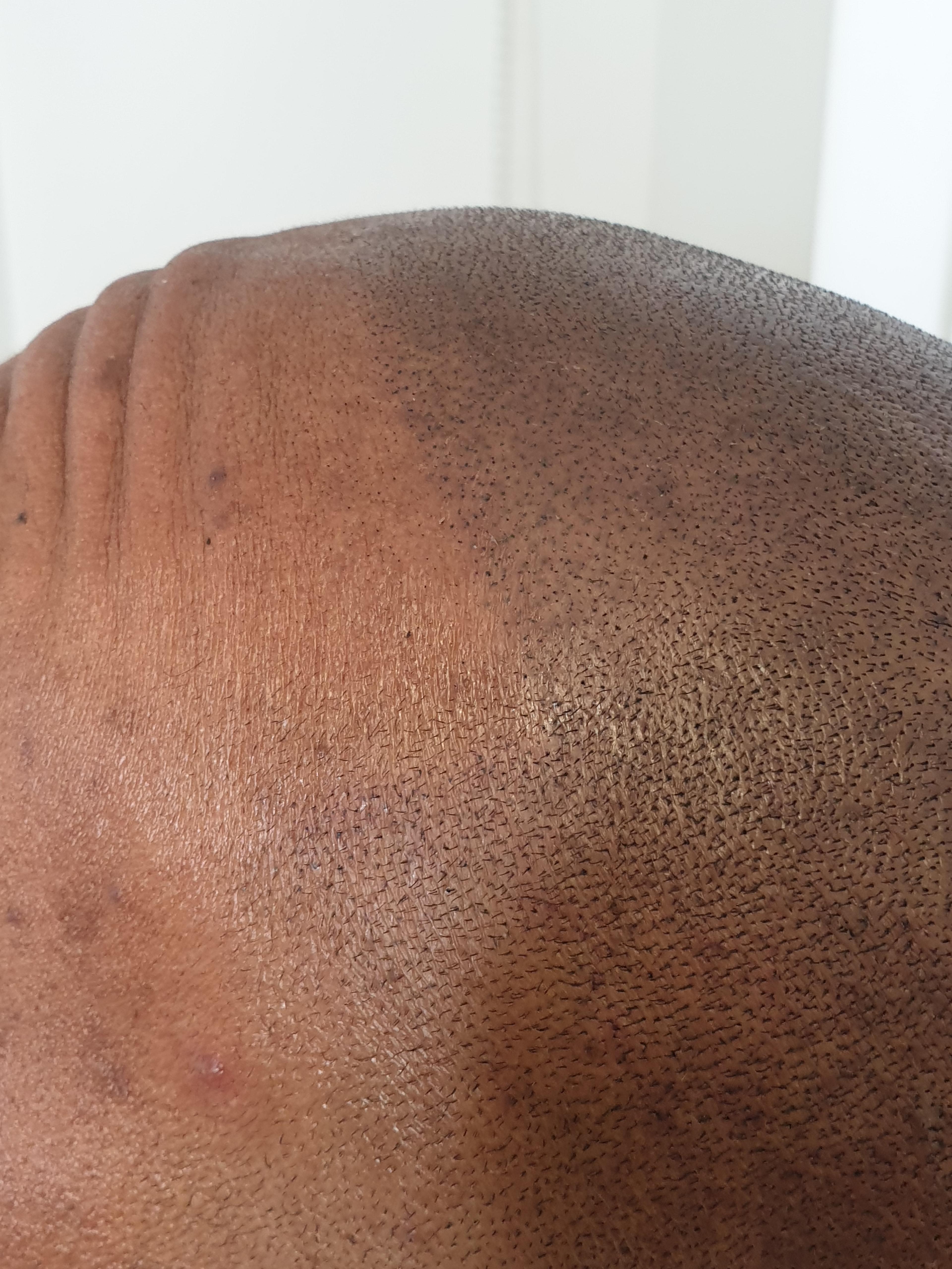Scalp Micro Pigmentation result close up
