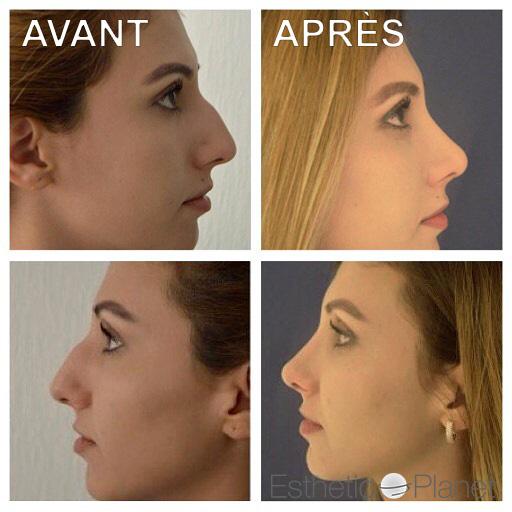 Rhinoplastie by Dr Ergin Er