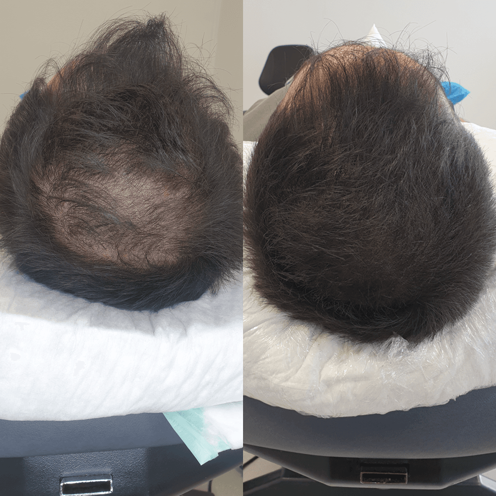 SMP VERTEX densification_