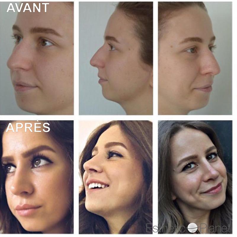 Rhinoplastie by Dr Ergin Er