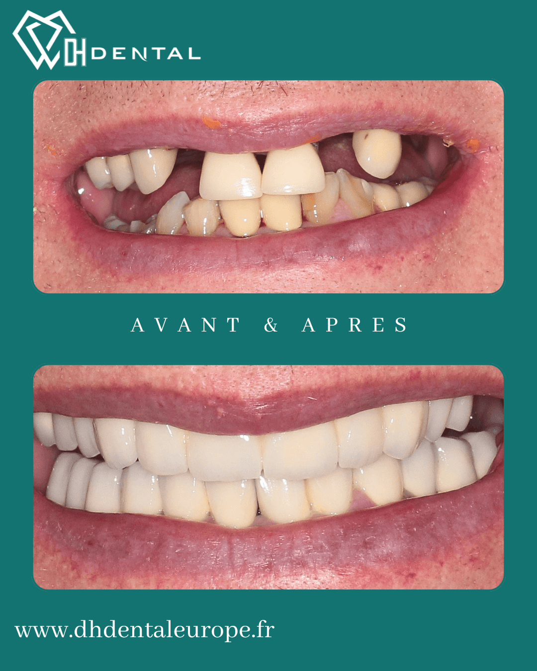 Implants dentaires et couronnes céramo-métalliques