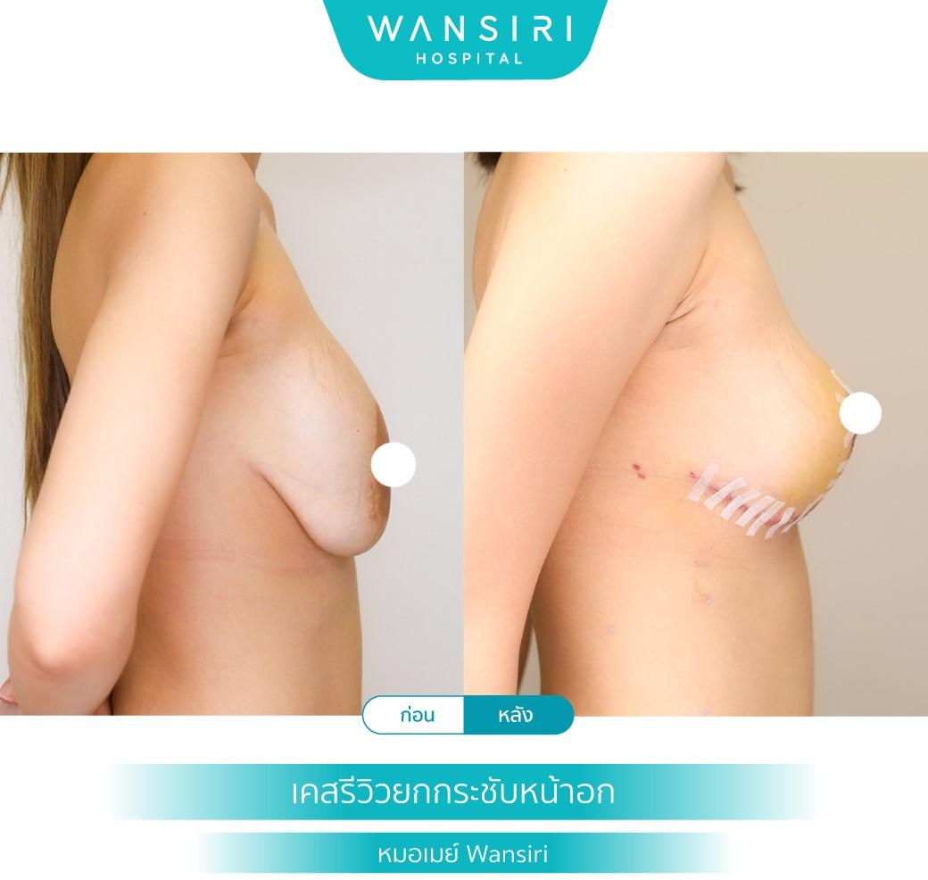 Wansiri Hospital Bangkok Breast Lift
