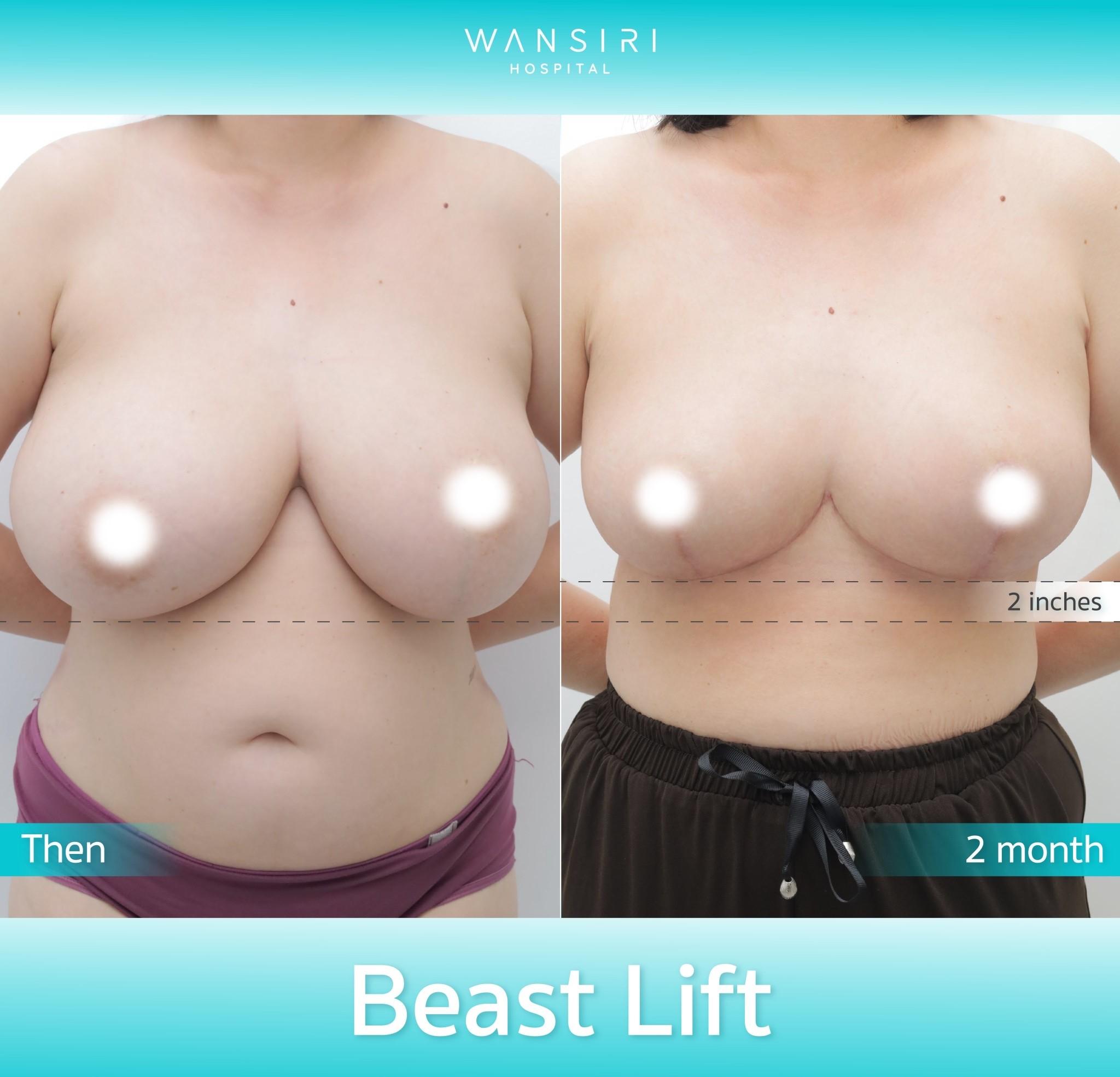 Wansiri Hospital Bangkok Breast Lift