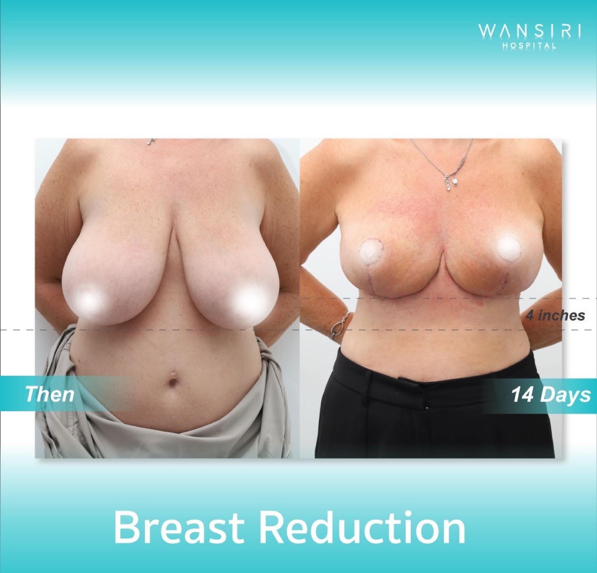 Wansiri Hospital Bangkok Breast Lift