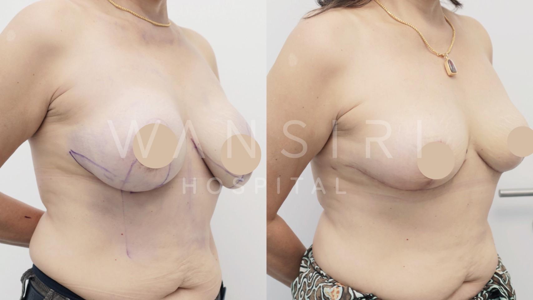 Wansiri Hospital Bangkok Breast Lift