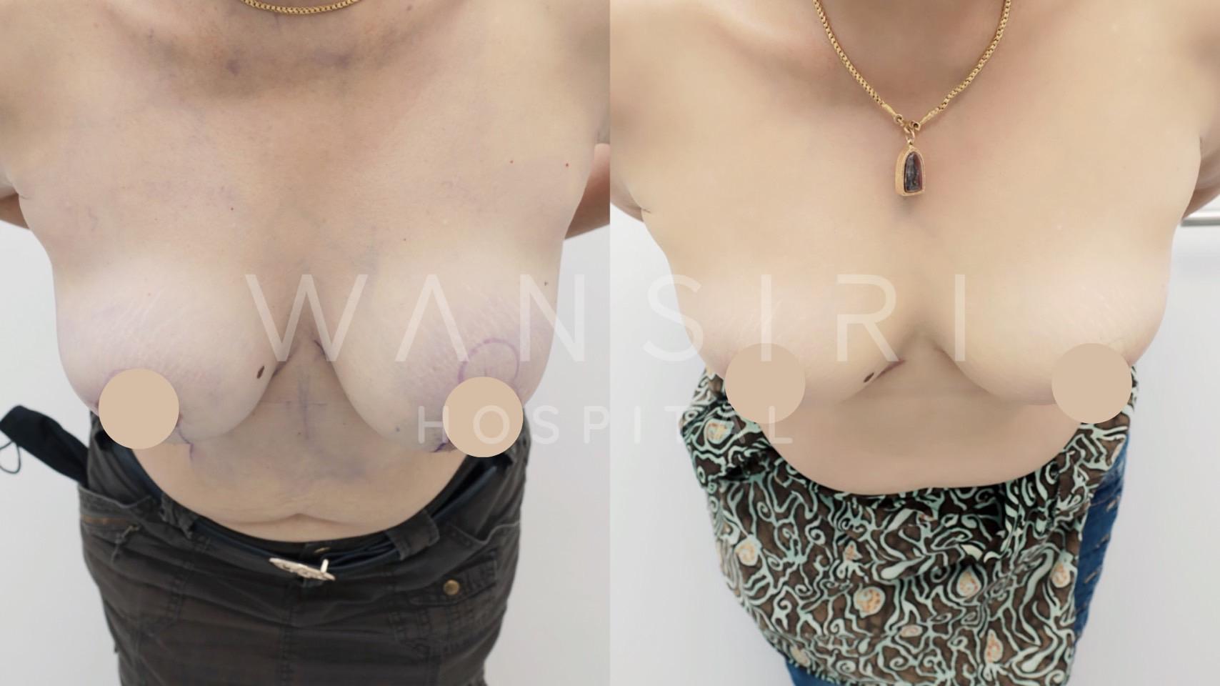 Wansiri Hospital Bangkok Breast Lift