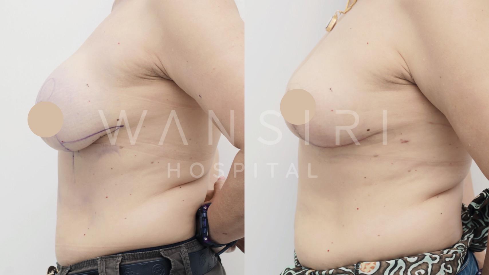 Wansiri Hospital Bangkok Breast Lift
