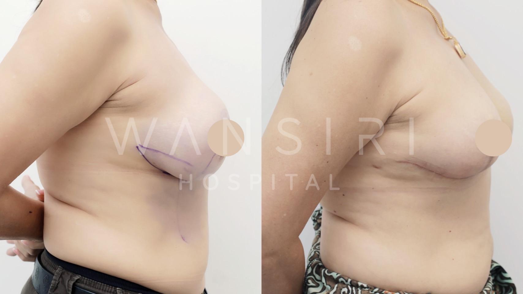 Wansiri Hospital Bangkok Breast Lift