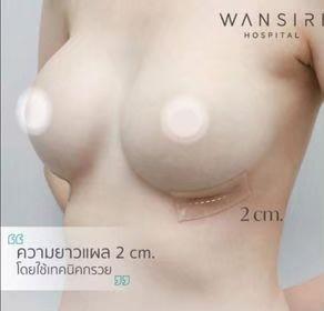 Wansiri breast augmentation