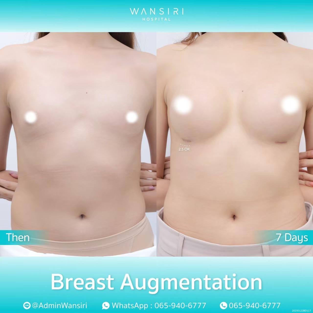 Wansiri breast augmentation