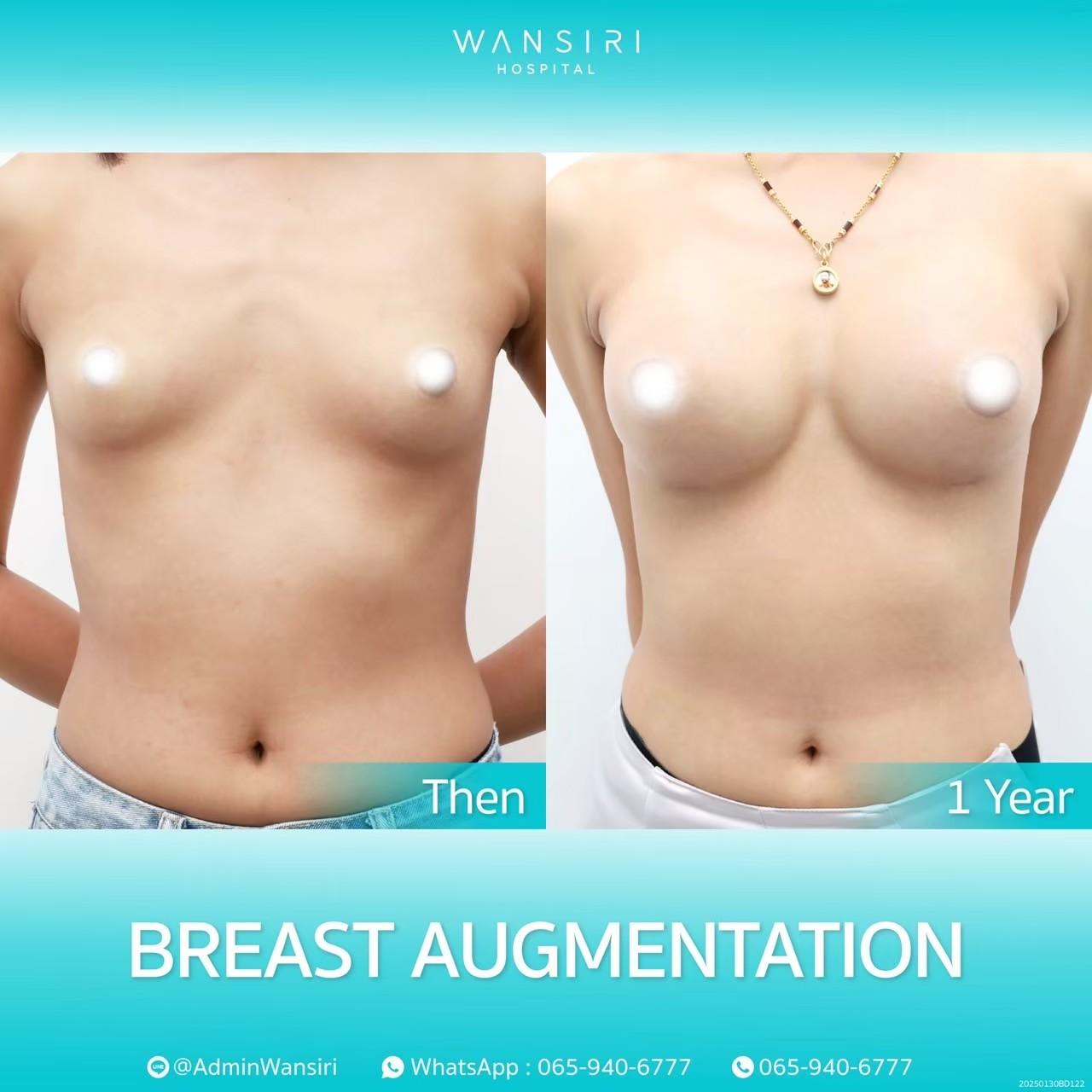 Wansiri breast augmentation