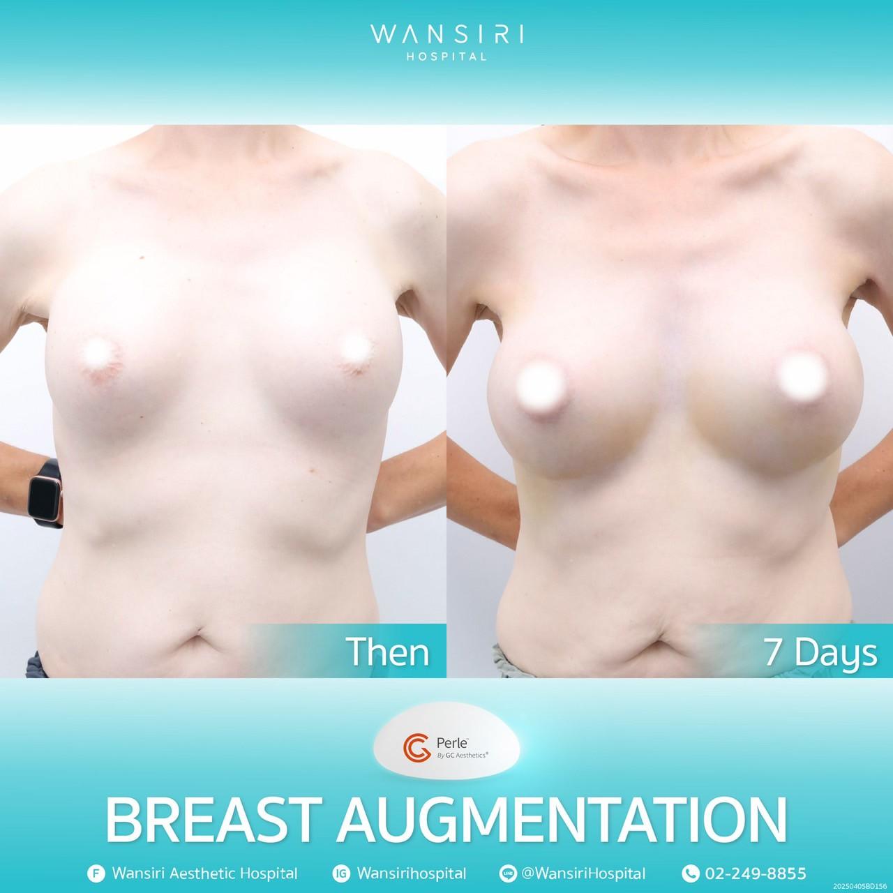 Wansiri breast augmentation