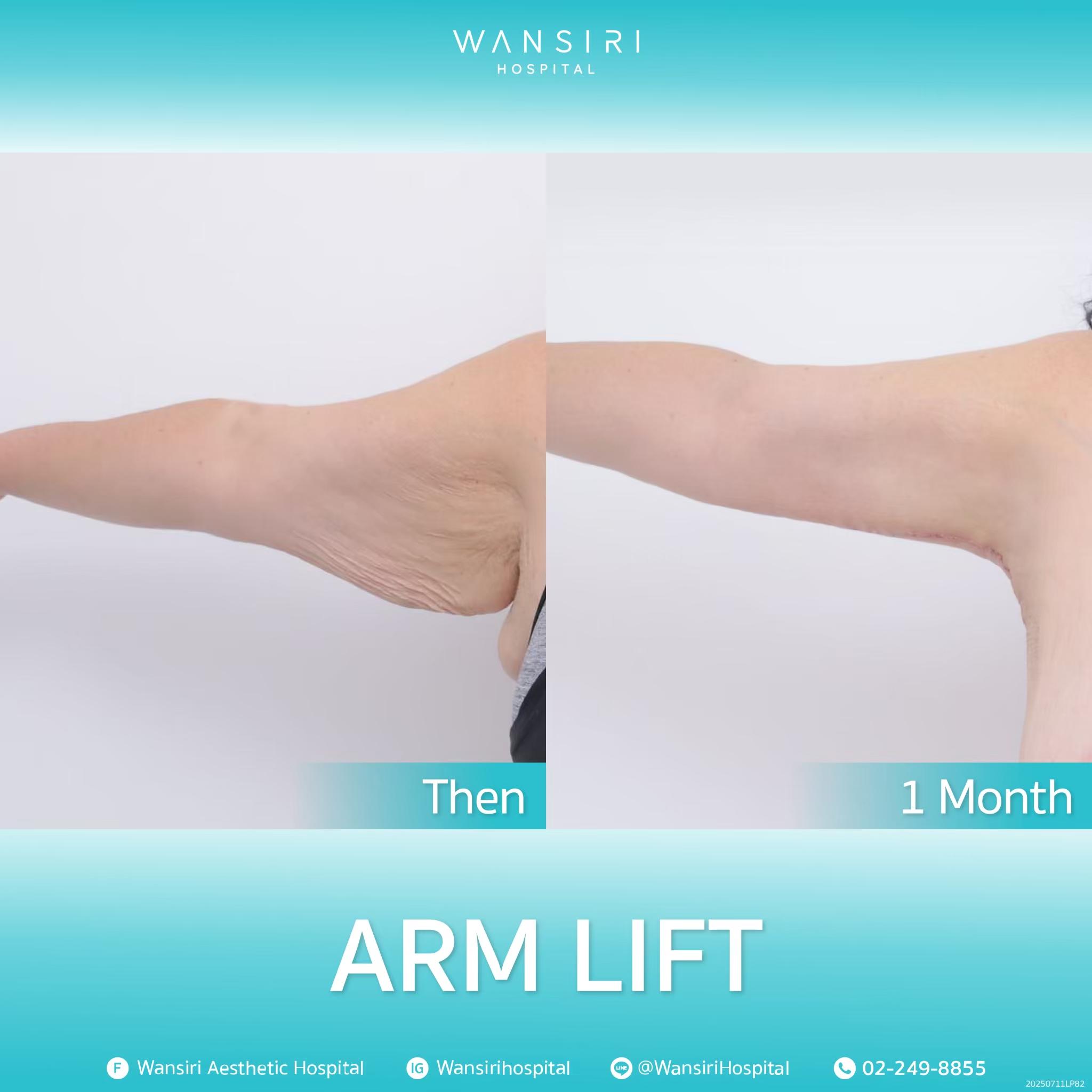 Wansiri Hospital Bangkok Arm Lift