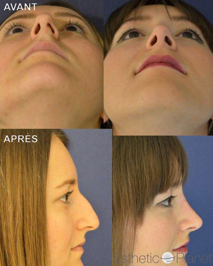 Rhinoplastie by Dr Ergin Er
