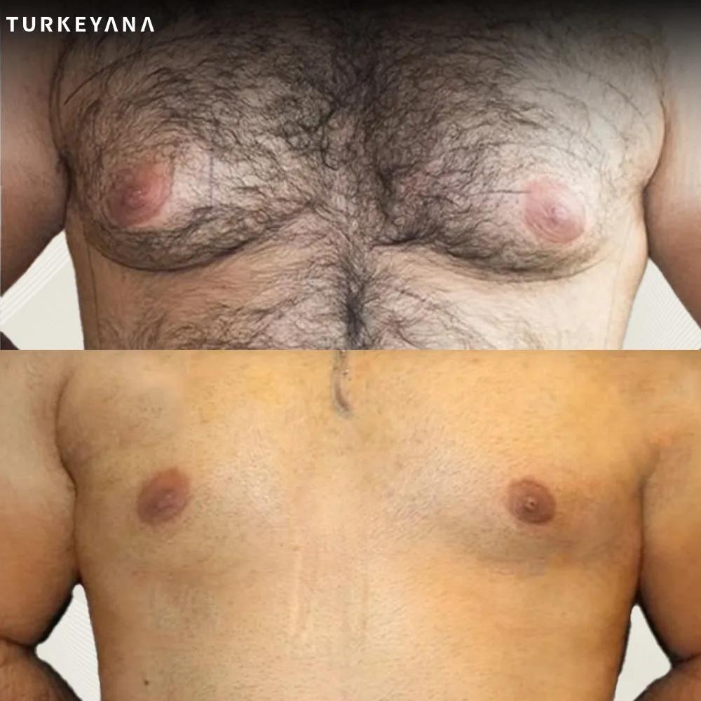 gynecomasty Istanbul