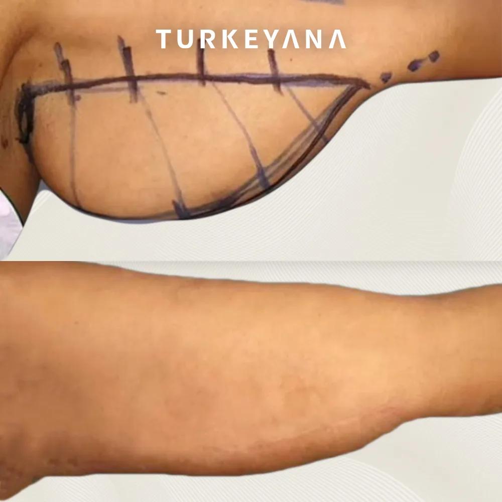 arm lift istanbul