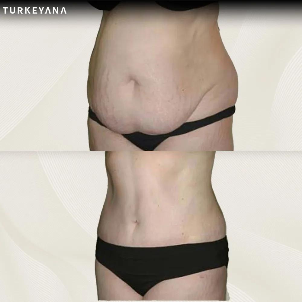 tummy tuck Istanbul