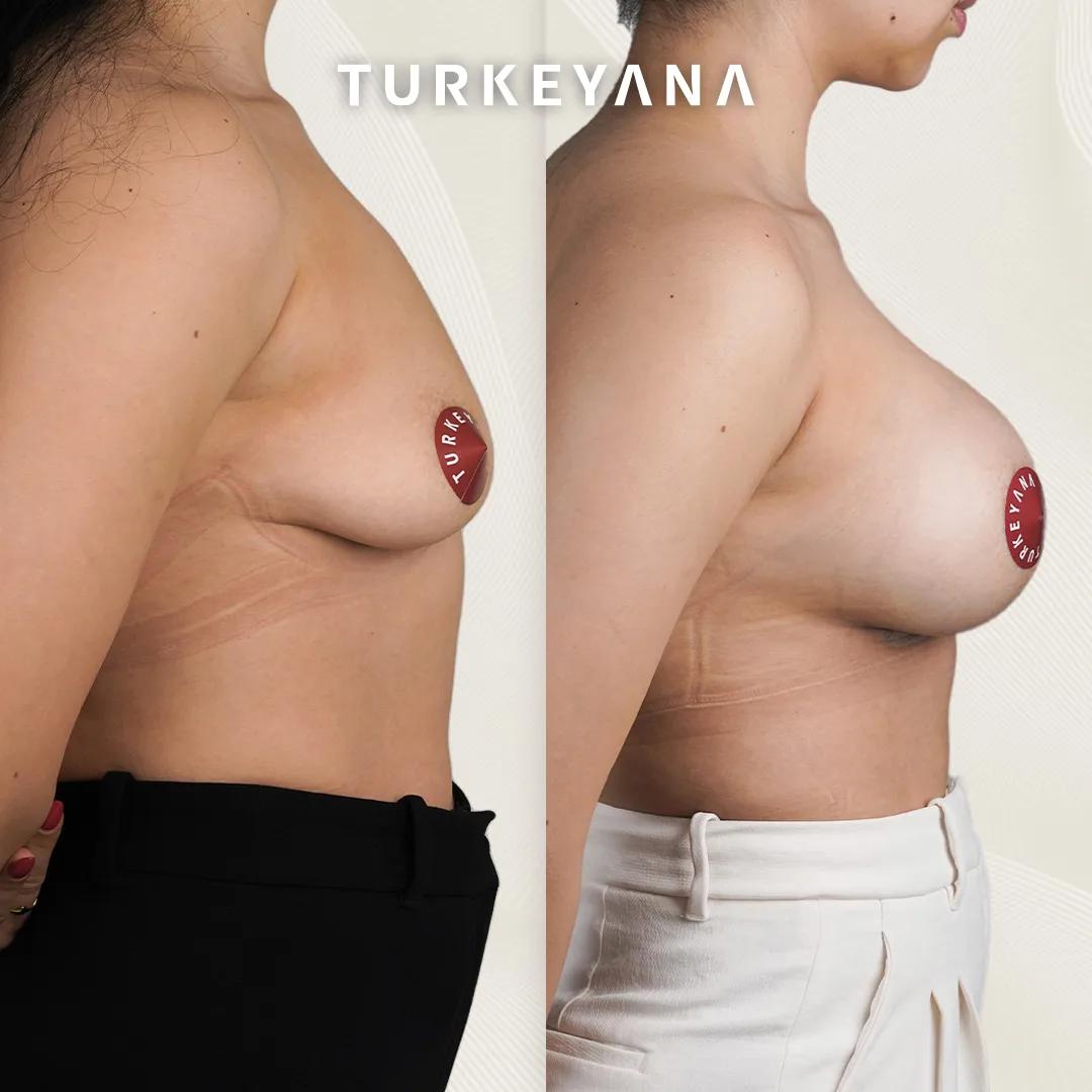breast results Istanbul